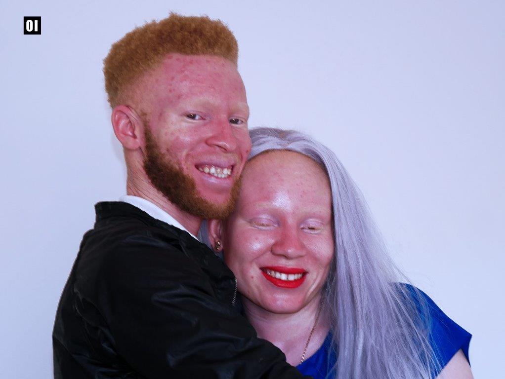 Benvinda Esperança: “Os albinos não curam doenças virais. Nós não somos medicamento”